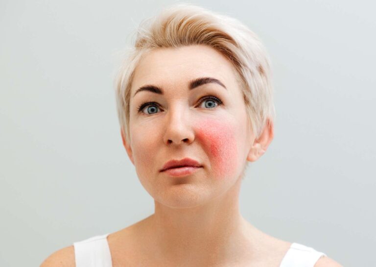 Self-Treatment for Eczema